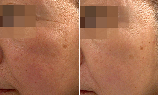 Before/After using Facial Treatment Essence
